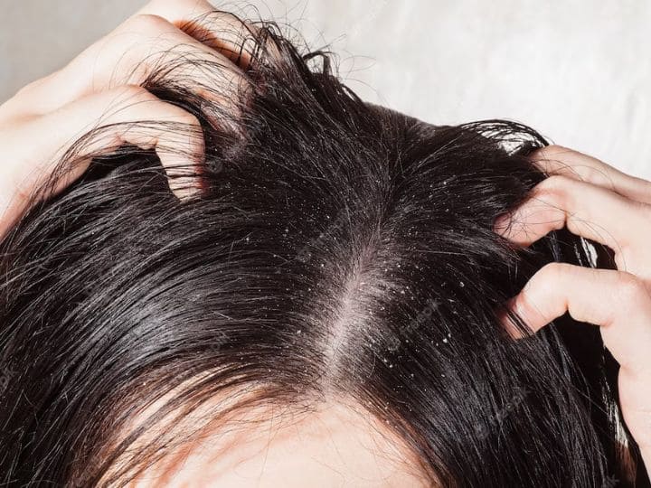 एंटी डैंड्रफ शैम्पू के साइड इफेक्ट जानिए क्यों यह शैम्पू आपके बालों के लिए अच्छा नहीं है